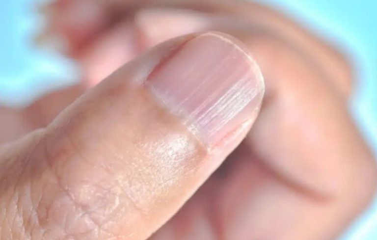 What Those Vertical Lines on Your Nails Really Mean — When to Worry (and When Not To)
