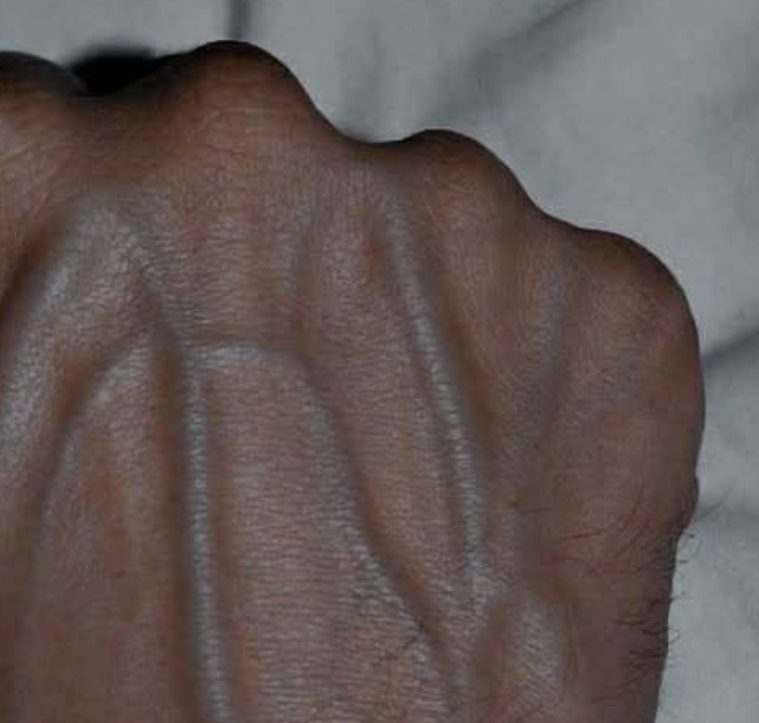 Visible Veins Explained: Normal Causes, Health Risks, and When to Worry