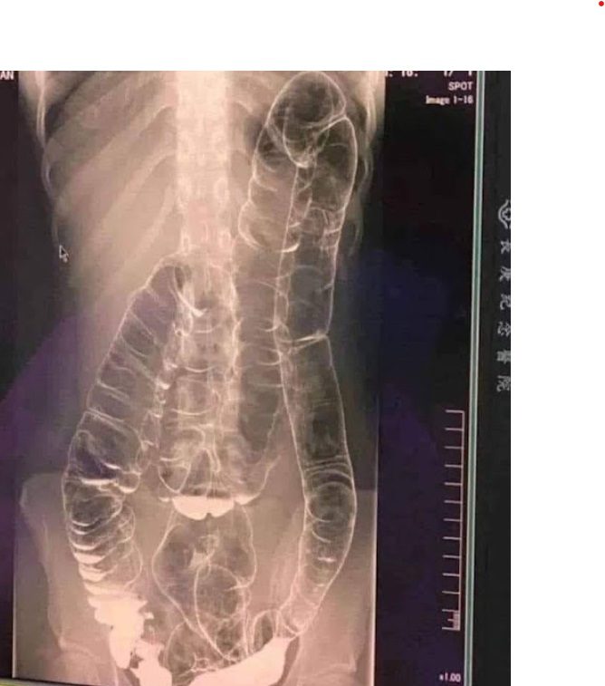 Severe Constipation and Toxic Megacolon: Causes and Solutions