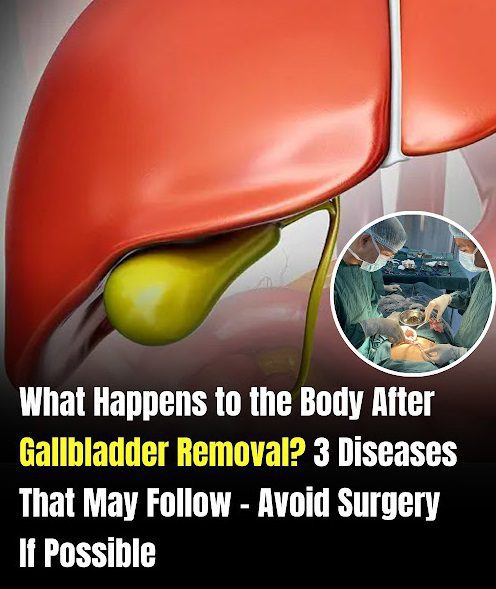 Life After Gallbladder Removal: Understanding the Possible Health Effects