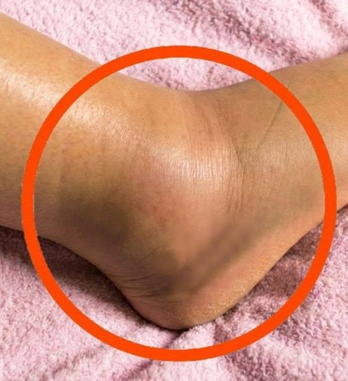 Swollen Legs: What Could It Mean? Common Causes You Should Never Ignore