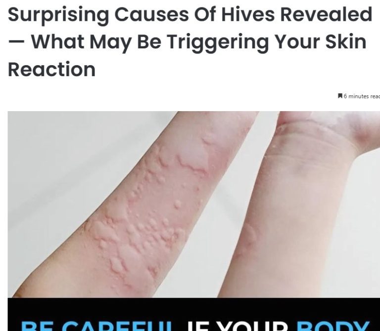 Surprising Causes Of Hives Revealed — What May Be Triggering Your Skin Reaction
