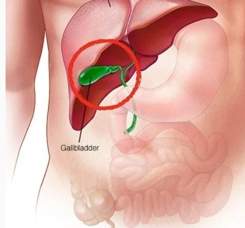 Understanding Possible Long-Term Effects After Gallbladder Removal