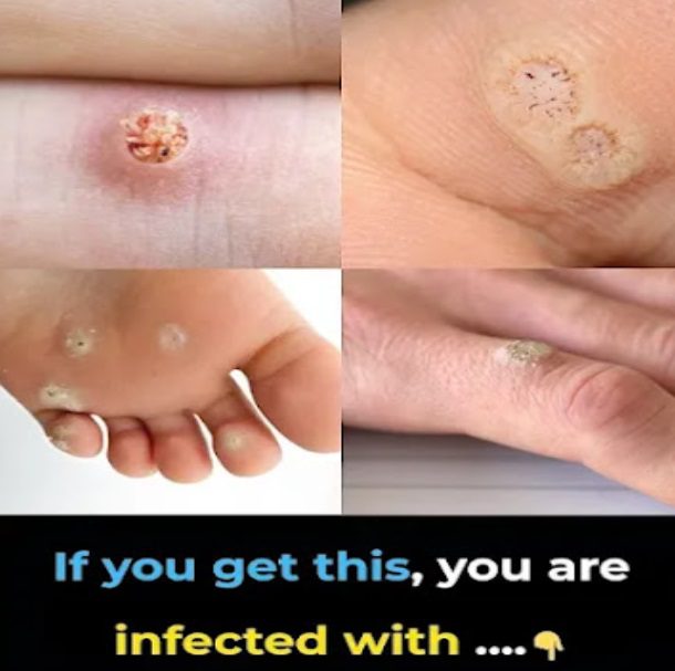 6 Types of Warts Explained: Signs, Symptoms, and Gentle Home Remedies (A Calm, Resourceful Guide)