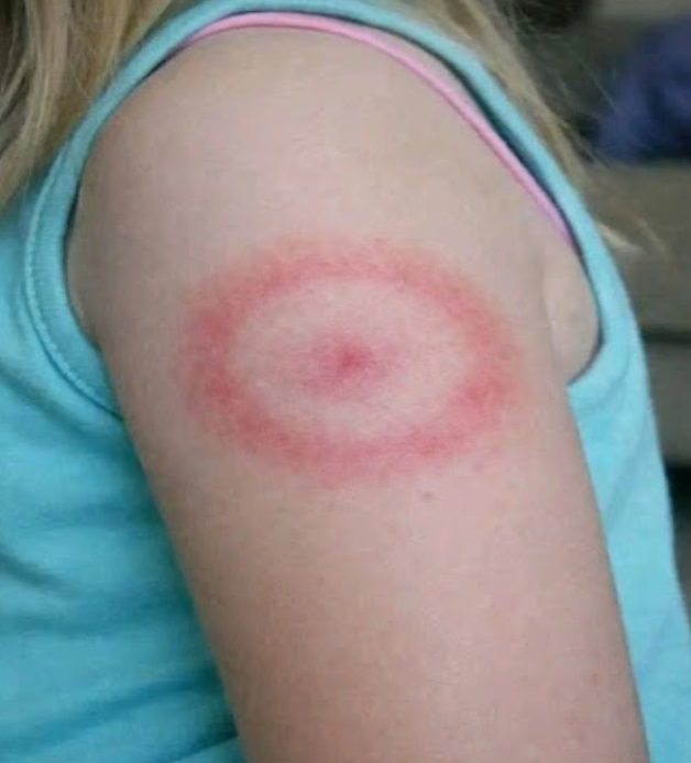 My Daughter Woke Up With a Strange Red Ring on Her Arm: A Parent’s Guide to Ring-Shaped Rashes (And When to Breathe Easy)