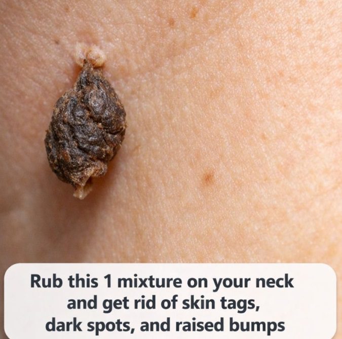 Rub this 1 mixture on your neck and get rid of skin tags, dark spots, and raised bumps