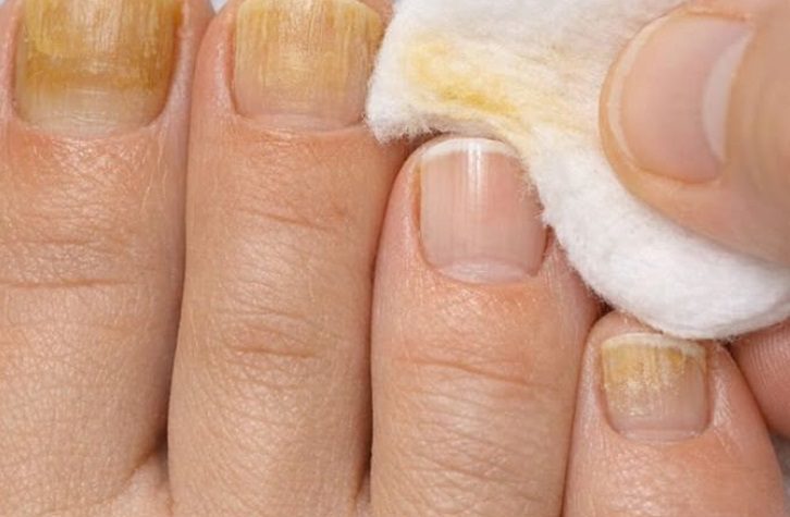 Rub this 1 trick on your nails and get rid of stubborn stains, yellow buildup, and rough texture