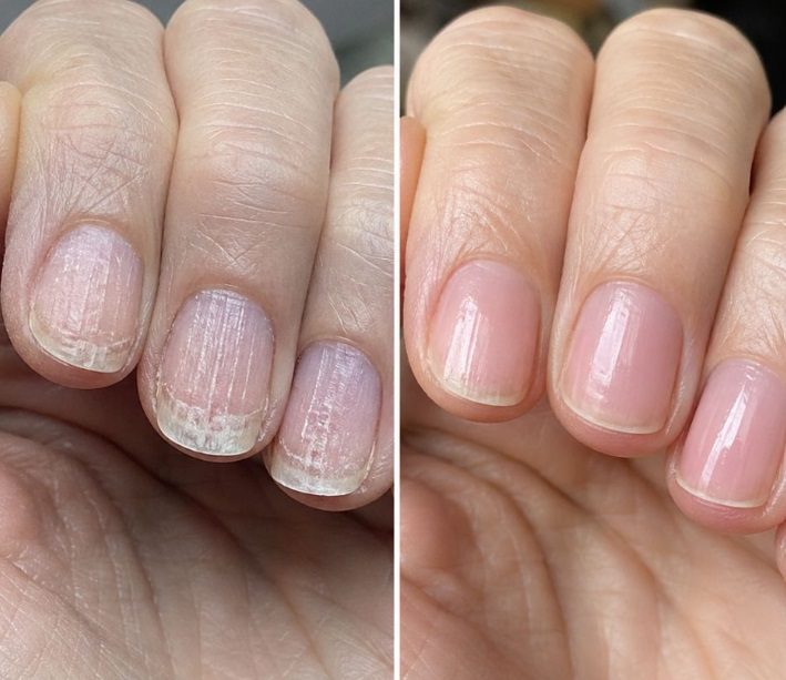Soak your nails in this 1 mixture and get rid of brittle ridges, vertical lines, and flaky layers