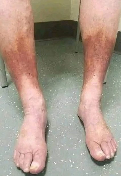 Swollen Legs and Darkened Skin: Could These Be Signs of Poor Circulation?