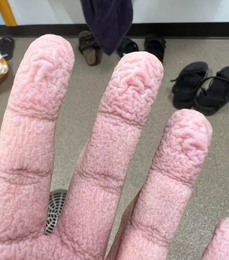 Wrinkled Fingers After Water Exposure: What Your Skin May Be Telling You