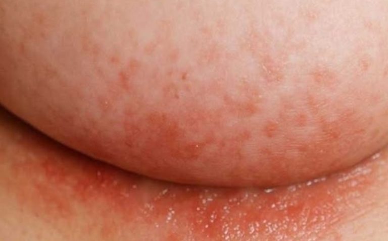 An itchy rash keeps flaring up under my breasts in winter, but my doctor isn’t available right now. What can I do today?