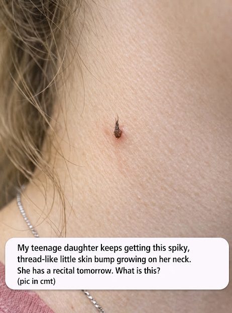My teenage daughter keeps getting this spiky, thread-like little skin bump growing on her neck. She has a recital tomorrow. What is this?.