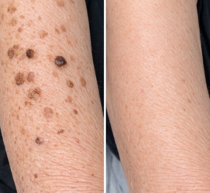 Rub this 1 mixture on your forearms and get rid of crusty spots, dark patches, and waxy growths