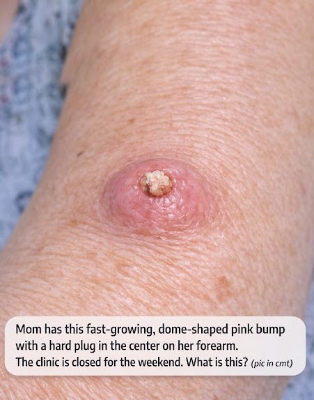 Mom has this fast-growing, dome-shaped pink bump with a hard plug in the center on her forearm. The clinic is closed for the weekend. What is this?