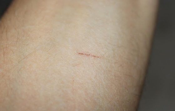 Why Do So Many People Have the Same Small Scar? The Mystery Behind a Global Mark